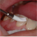 Dental Instruments