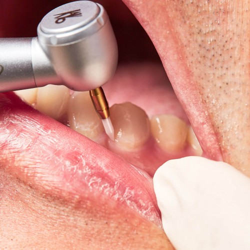CTT™ - Ceramic Tissue Trimmer