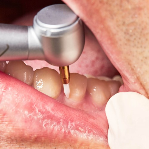 CTT™ - Ceramic Tissue Trimmer